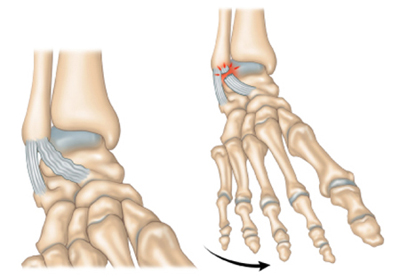 Ligamentoplastie Centre Orthop dique Pasteur Lanroze